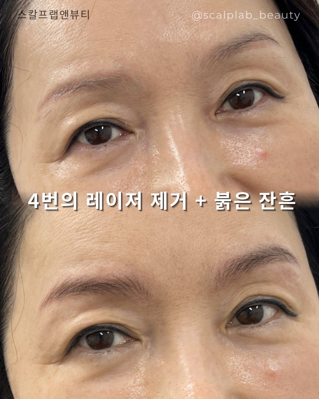 레이저 제거 후 잔흔 커버