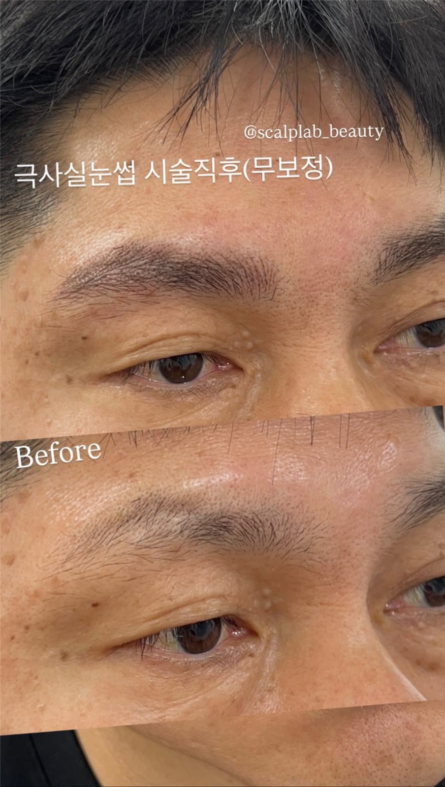 극사실눈썹 · 시술 직후 무보정