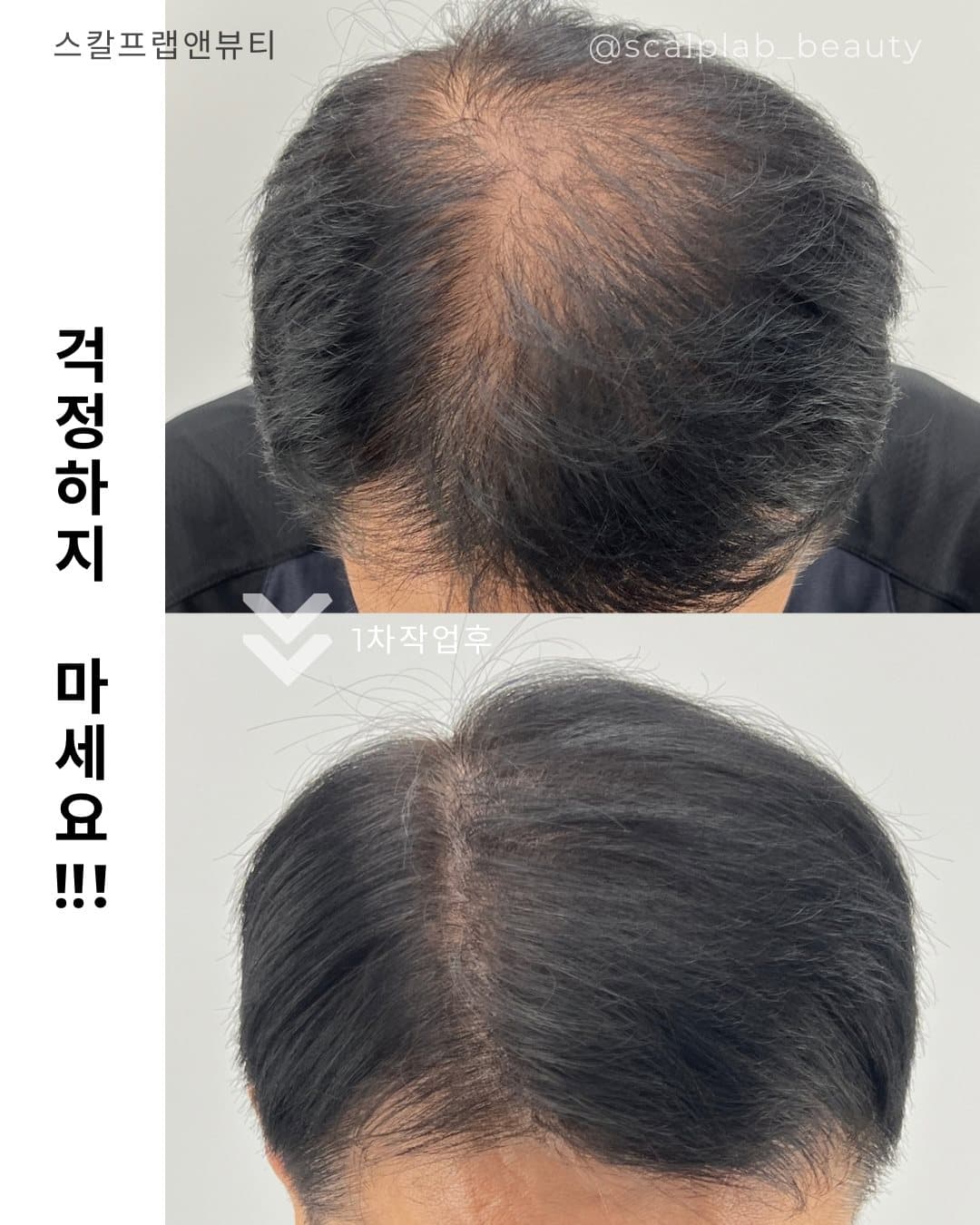 정수리 탈모커버 전·후