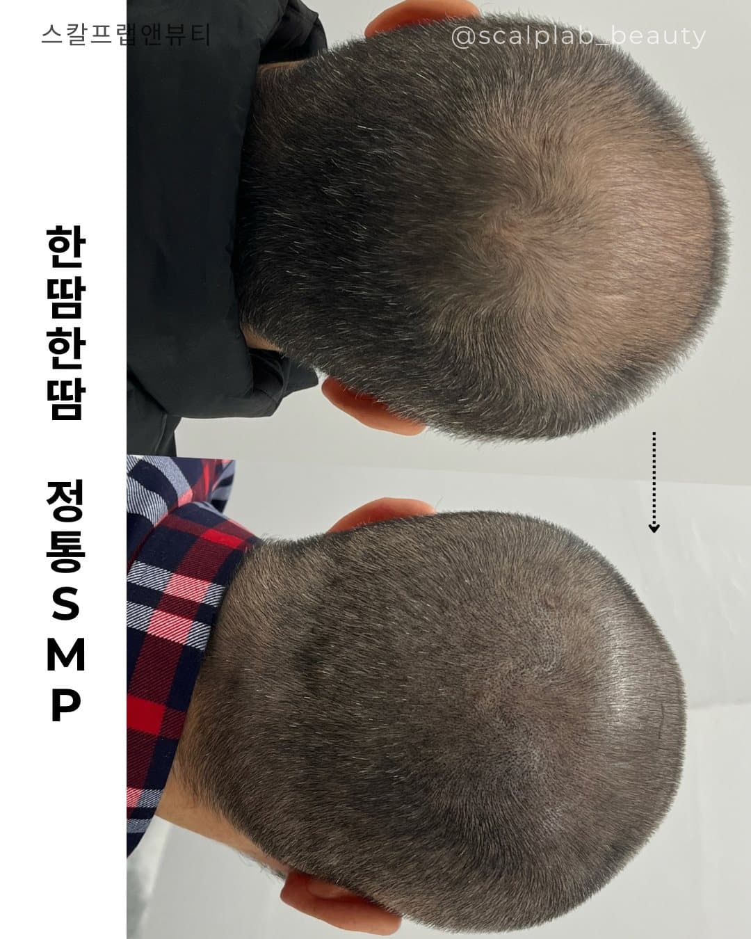 두피·헤어라인 · 삭발 정통 SMP 전·후